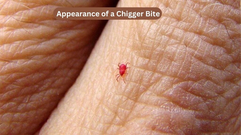 Appearance of a Chigger Bite